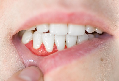 Composite Fillings