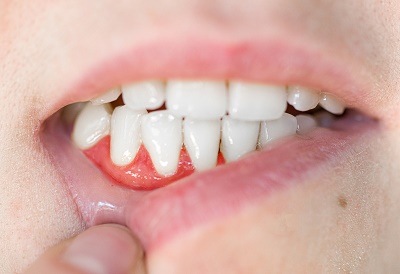 Dental Implant Procedure