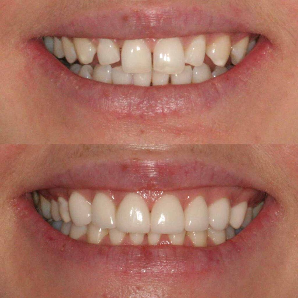 Cosmetic Dental Bonding
