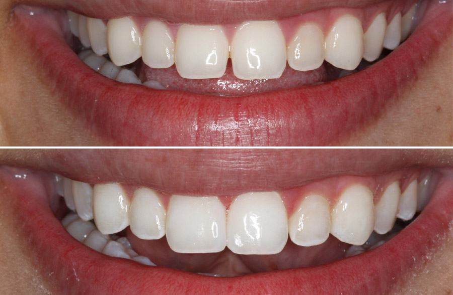 Cosmetic Dental Bonding