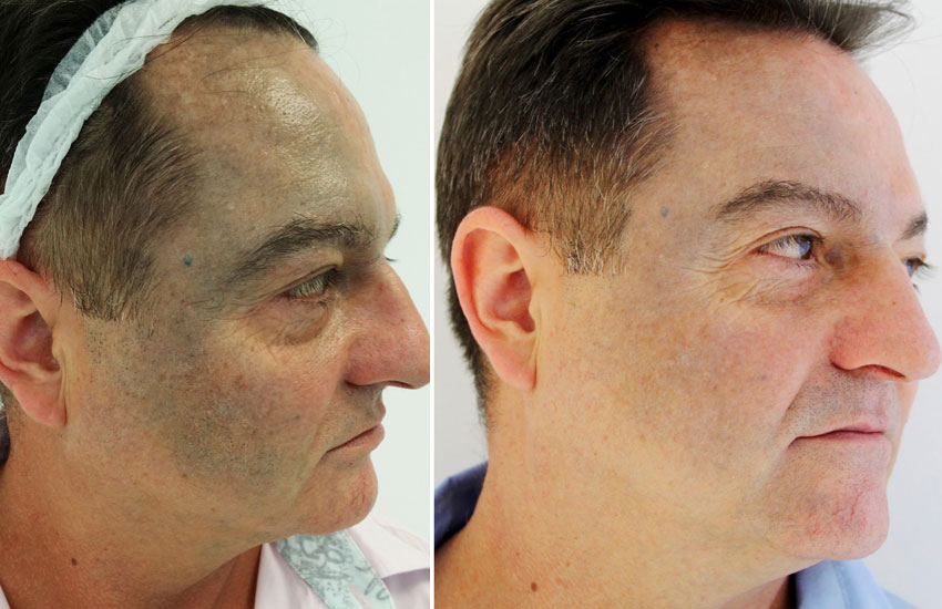 nevus of ota laser treatment