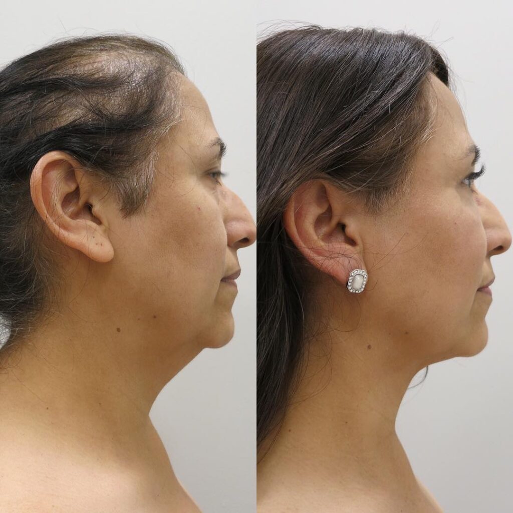 Cheek Reduction Surgery