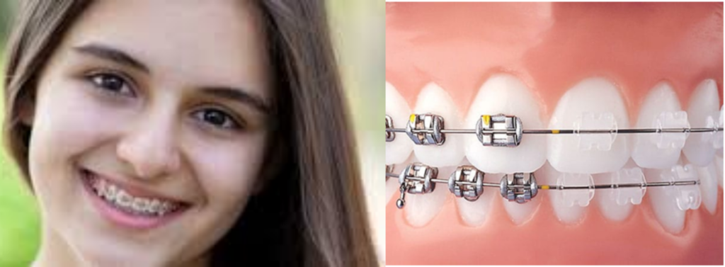 invisalign teeth braces