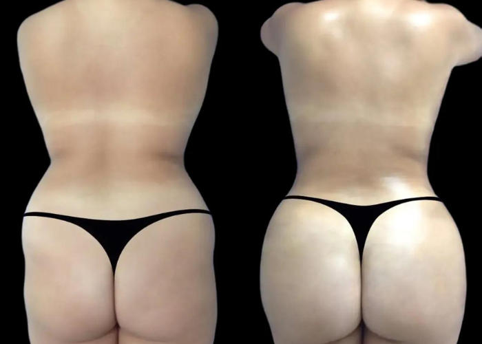 How Butt Fillers Can Enhance Your Figure in Dubai