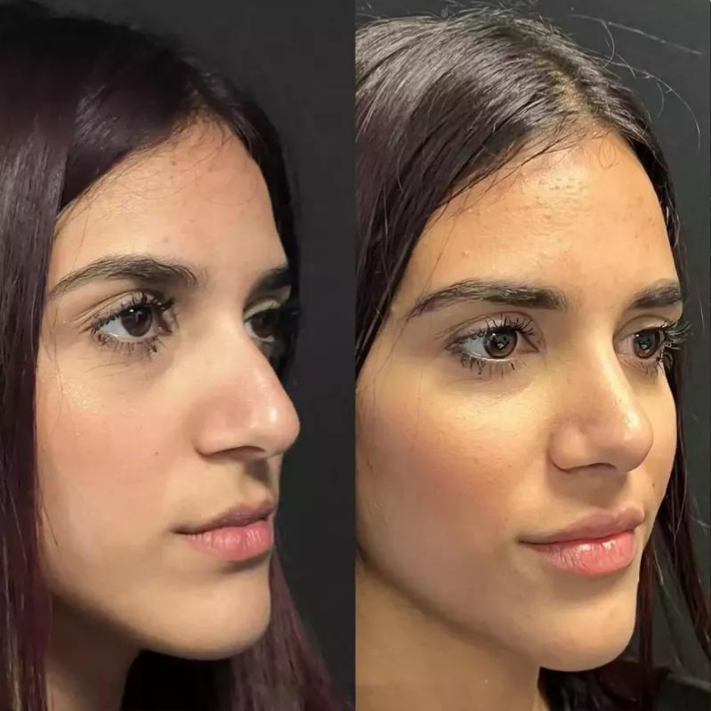 Rhinoplasty in Dubai: Avoid Alcohol Before and After Surgery