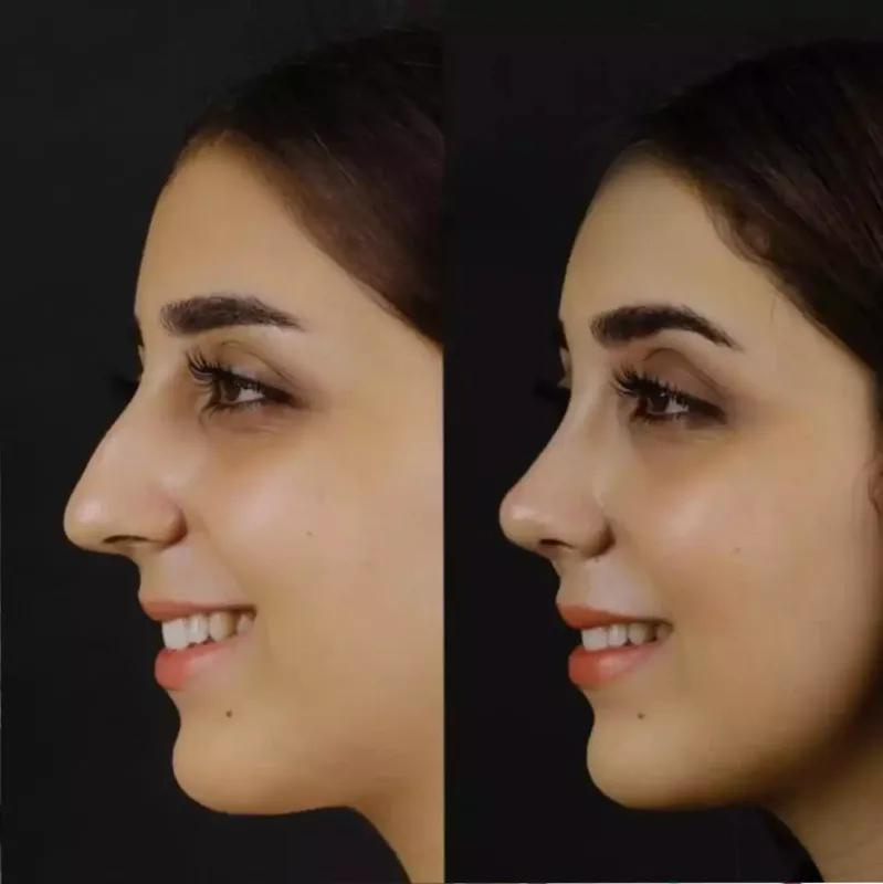 Affordable Rhinoplasty in Dubai: Quality Meets Cost