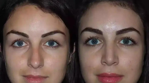 Nose Surgery in Dubai: Enhancing Both Function and Aesthetics
