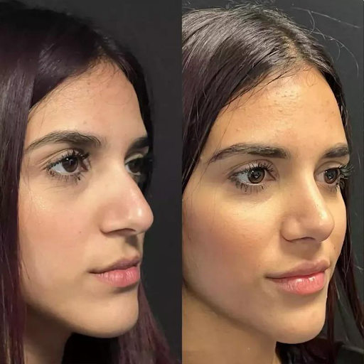 Why Experience Matters: Finding the Best Rhinoplasty Surgeon in Dubai