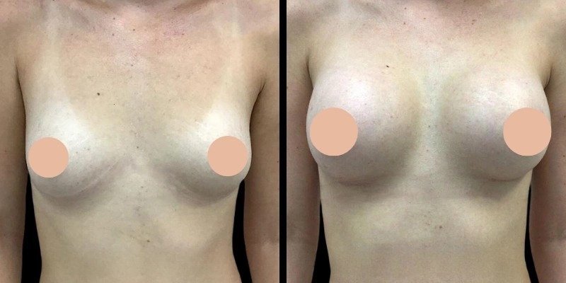 How the Best Doctors in Dubai Personalize Your Breast Augmentation Experience