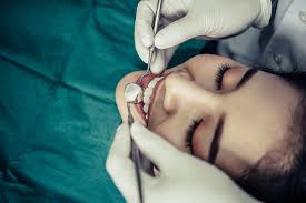 All-on-4 Dental Implants Houston