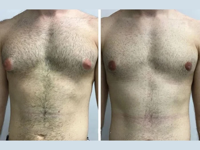 Technology & Techniques Used by the Best Doctors in Dubai for Gynecomastia