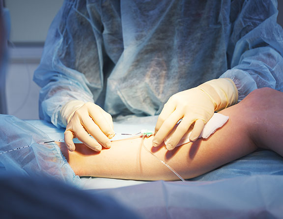 Is Varicose Vein Treatment Covered by Insurance?